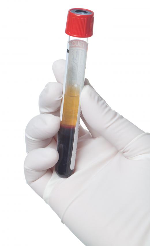 Hepatitis C can be detected in the tests that are performed on donated blood.