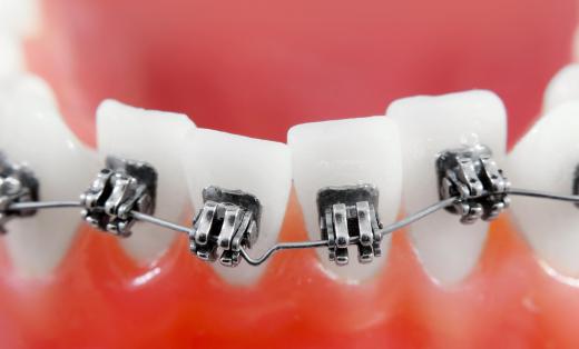 Orthodontists straighten patients' crooked teeth using metal braces.