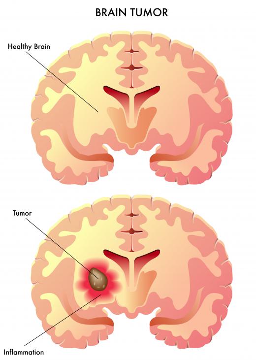 Carmustine may be used to treat brain tumors.