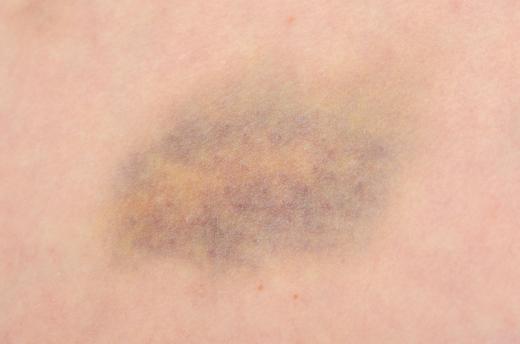 Bruising may be a symptom of cutaneous vasculitis.