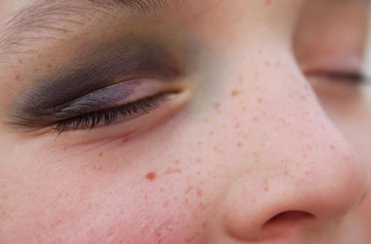 Black eyes may be a sign of abuse.