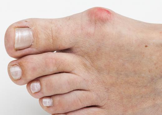 Redness and swelling are common with bunions.