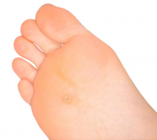 Diabetes increases the occurrence of calluses.