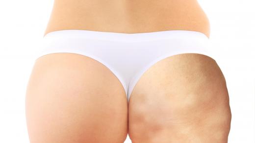 Anti-cellulite creams can keep skin moisturized, which will reduce the appearance of wrinkles over time.