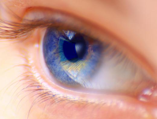 An ocular melanoma can affect the iris, the colored part of the eye.