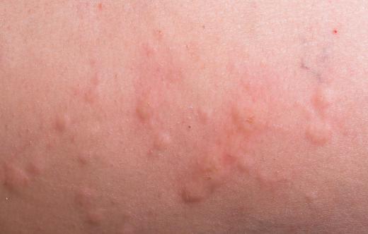 Signs of an allergic reaction to propolis capsules may include hives.