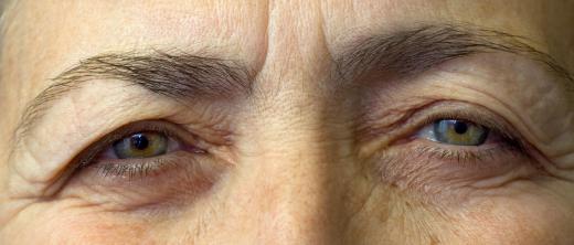 Aging may cause ptosis, or droopy eyelids.