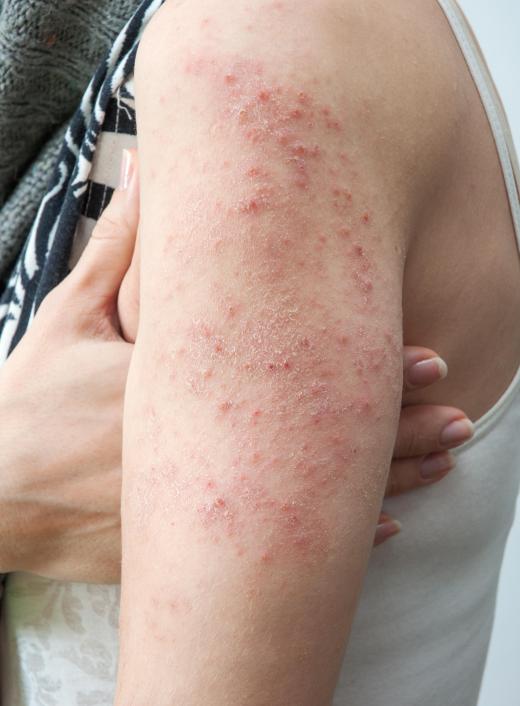 Many viral skin infections are contagious.