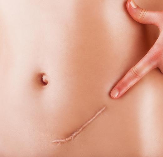 Some people opt to have additional surgical procedures in an attempt to minimize their scars.