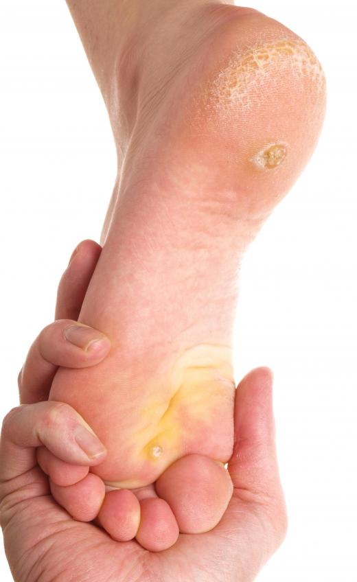 Plantar warts appear on the bottom of the foot or toes.