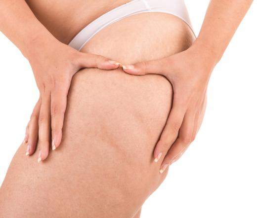 Liposuction is not guaranteed to produce results.