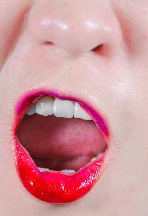 Someone with ankyloglossia may have a limited range of motion in his or her tongue.