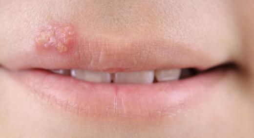 Glycolic peels are not a good idea for those who experience recurring cold sores.