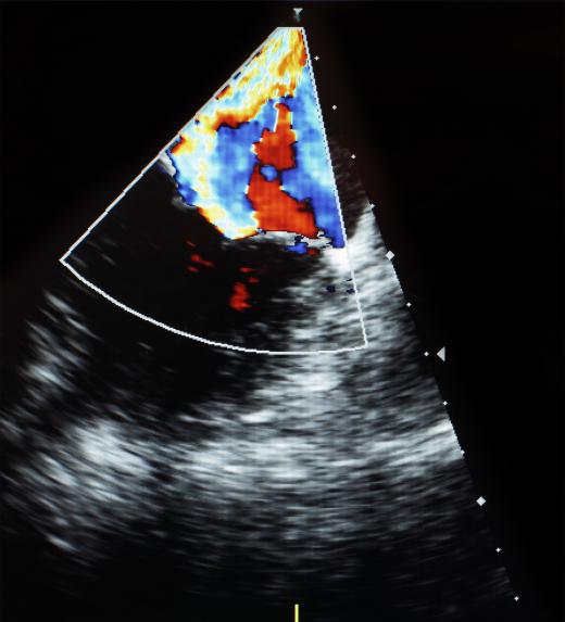 A stress echocardiogram uses high frequency sound waves that are transmitted into the heart to detect its shape, size, and motion.