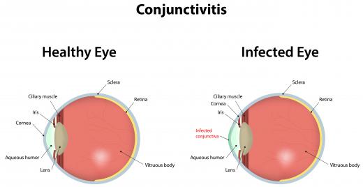 Bacterial conjunctivitis is an infection of the clear outer surface of the eye.