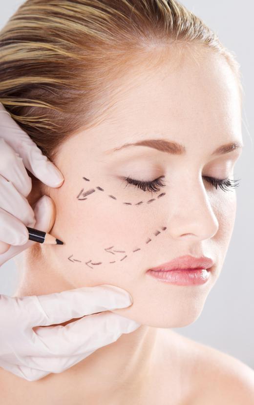 A woman preparing to get cheek implants.