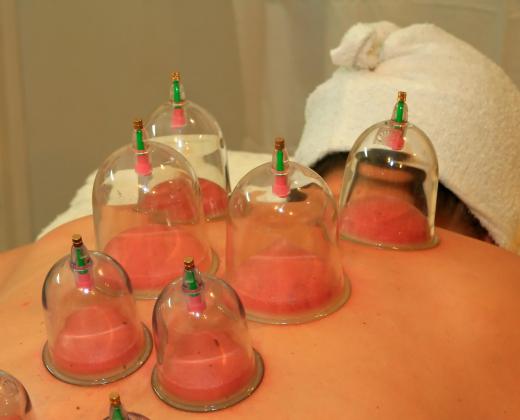 Cupping and acupuncture stem from traditional Chinese medical treatments.