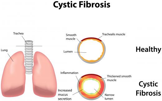 Up-to-date therapy and management of cystic fibrosis includes inhaled medications and airway clearance techniques.