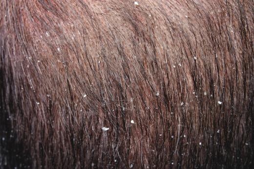 Coconut hair oil can help someone with dandruff.