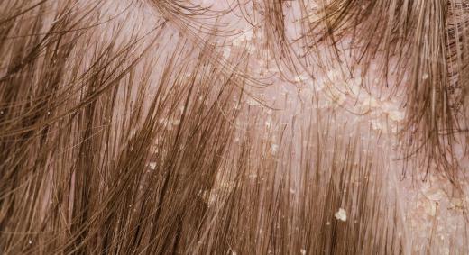 There are many ways to treat dandruff, which can cause an itching scalp.