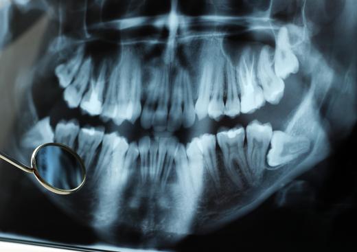 Third mandibular molars are commonly known as "wisdom teeth."