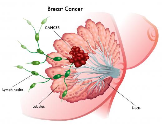 A breast excision operation often only removes a small portion of the breast cells, including all the abnormal cells.