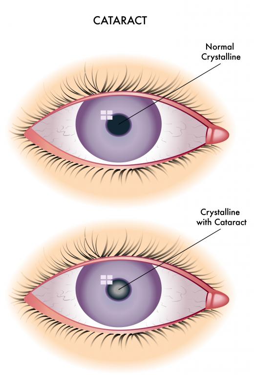 Cataracts occur when part of the eye is damaged and the eyes' lenses become cloudy.