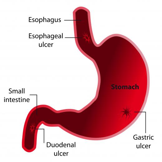 A barium meal may be used to help doctors see an ulcer.