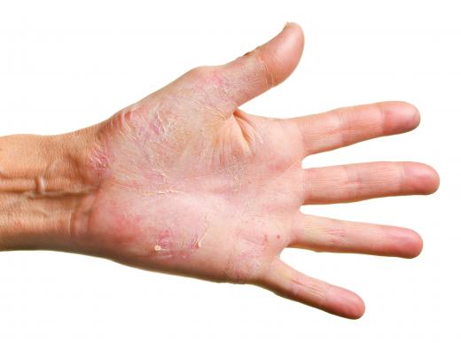 Some intolerance and allergies, such as a gluten allergy, can cause dermatitis herpetiformis.