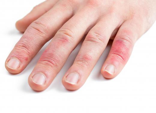 Asteatotic eczema can effect the hands.