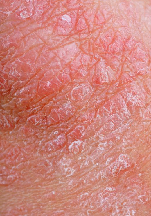 Dermatitis commonly causes a red rash on the skin.