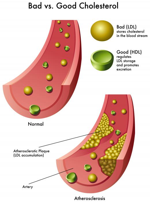 LDL cholesterol negatively impacts the body by accumulating in the arteries and increase the risk of heart attack and stroke.