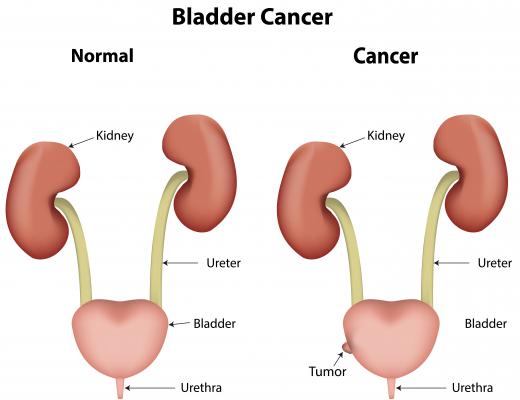 Patients who have take cyclophosphamide have a higher risk of developing bladder cancer.