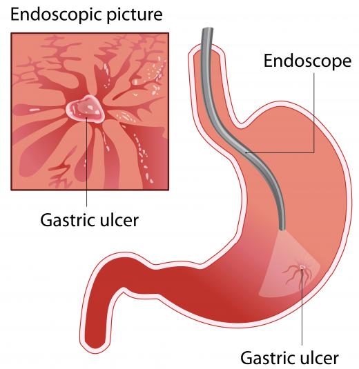 A wireless capsule endoscopy may be used to diagnose gastric ulcers.