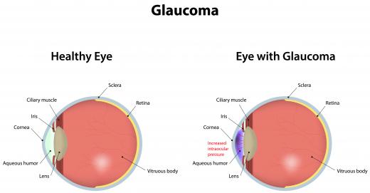 A history of glaucoma puts someone more at risk for blockages in the central retinal vein.