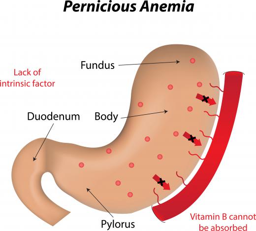 Liquid vitamin B12 may be used to treat pernicious anemia, a condition in which the body struggles to absorb vitamin B12.