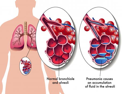 Pneumonia can be caused by a bacterial, viral, or fungal infection of the lungs.