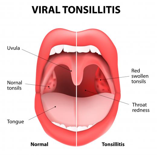 Viral tonsillitis is a common cause of tonsil inflammation.