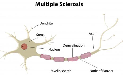 Multiple sclerosis is known to have a serious impact on the integrity of the myelin sheath.