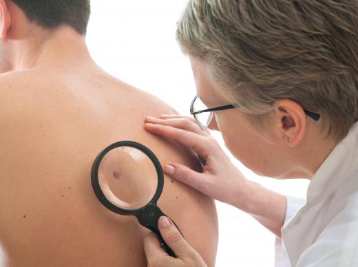 The growth of irregular moles is often a sign of melanoma.