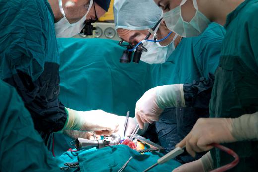 A transhiatal esophagectomy is performed to remove a damaged esophagus.