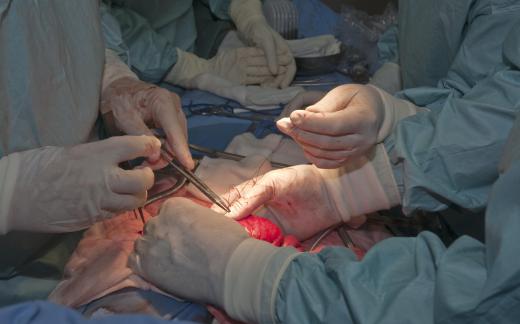 Mitral valve prolapse surgery might be performed to prevent heart failure.