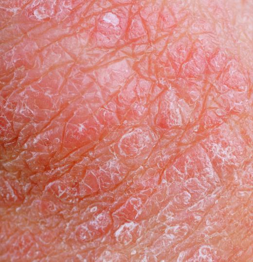 Trichologist may treat eczema.