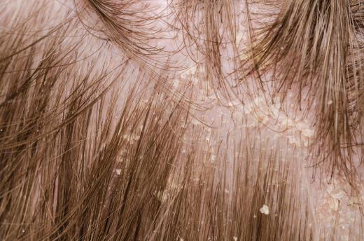 Dry skin may cause an itchy, flaky scalp.