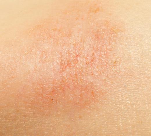 While more severe cases of ichthyosis can appear like scales on the skin, less severe cases can appear like typical dry skin that covers the body.