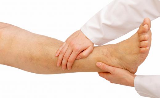 Water retention from chronic nephritis can cause edema in the legs and feet.