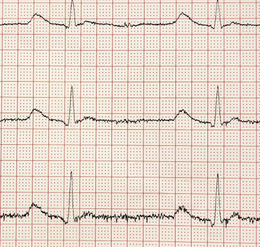 The electrical impulses of the brain appear as wavy lines on an EEG recording.