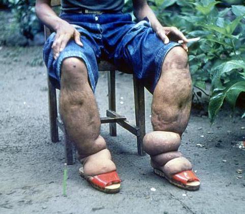 Lymphatic filariasis may lead to the development of elephantiasis, or excessive swelling in the extremities.