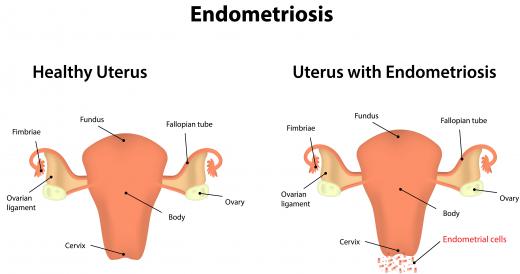 Painful menstrual periods are one of the signs of endometriosis.