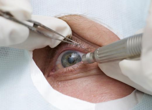 During the most common cataract surgery, the opthamologist makes a small incision in the eye and inserts a fine probe.